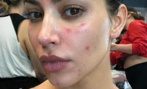 Por primera vez Kim Kardashian muestra la enfermedad que sufre en su rostro